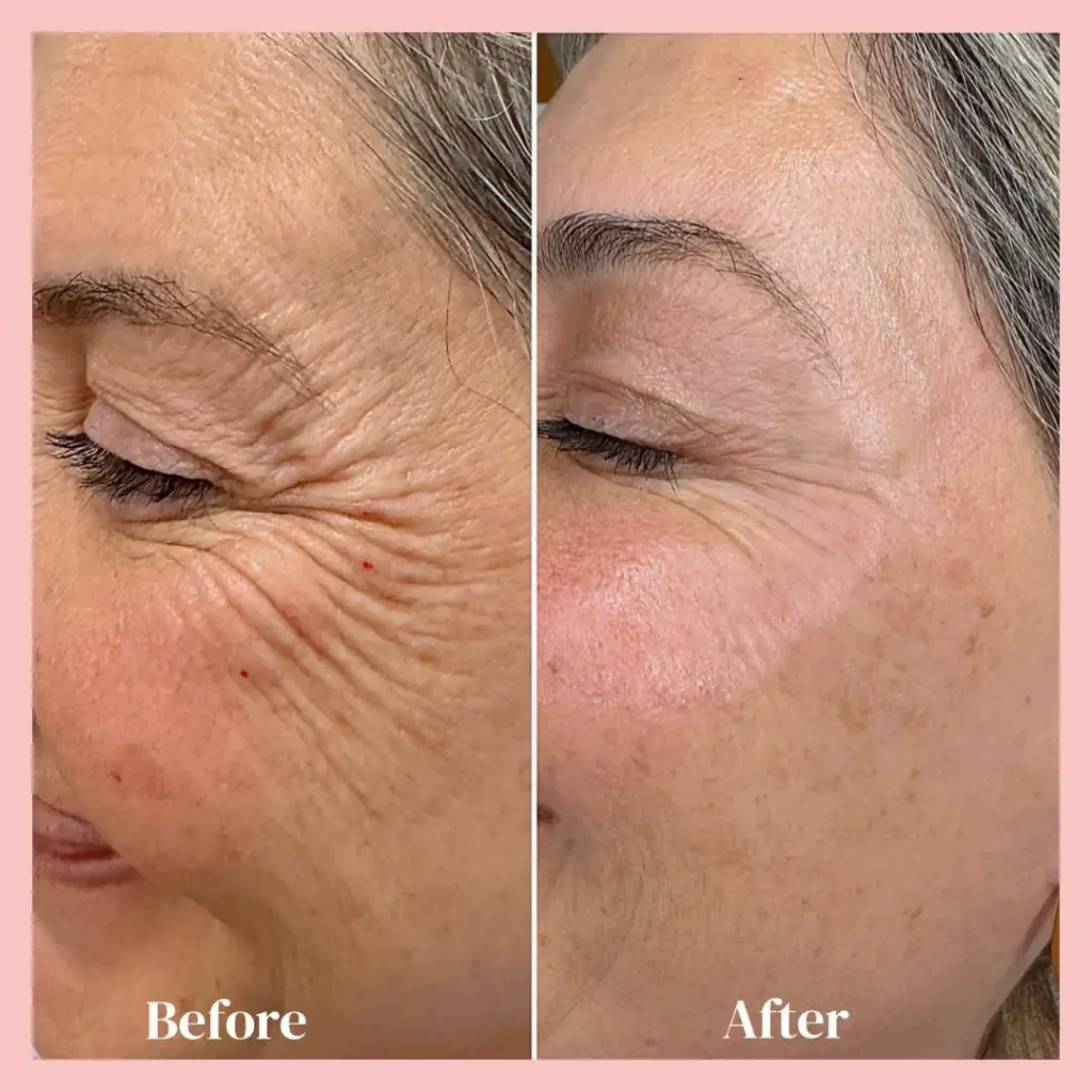 בוטוקס צידי עיניים לאישה להעלמת קמטים עם דיספורט 500