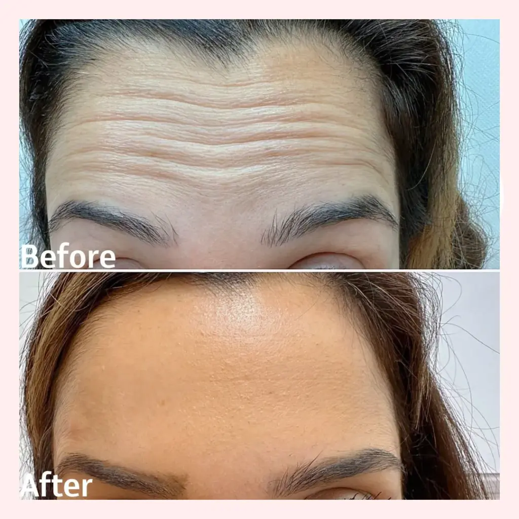 בוטוקס במצח לאישה להעלמת קמטים עם דיספורט 500