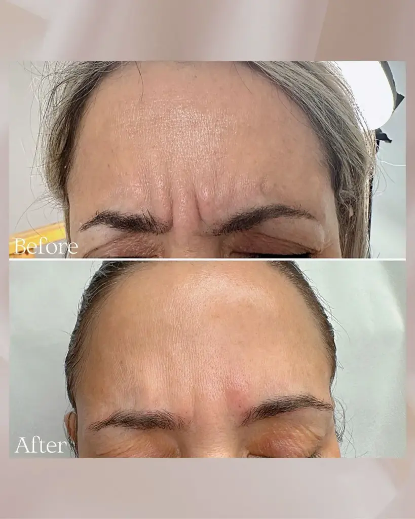 בוטוקס בין הגבות לאישה עם דיספורט 500