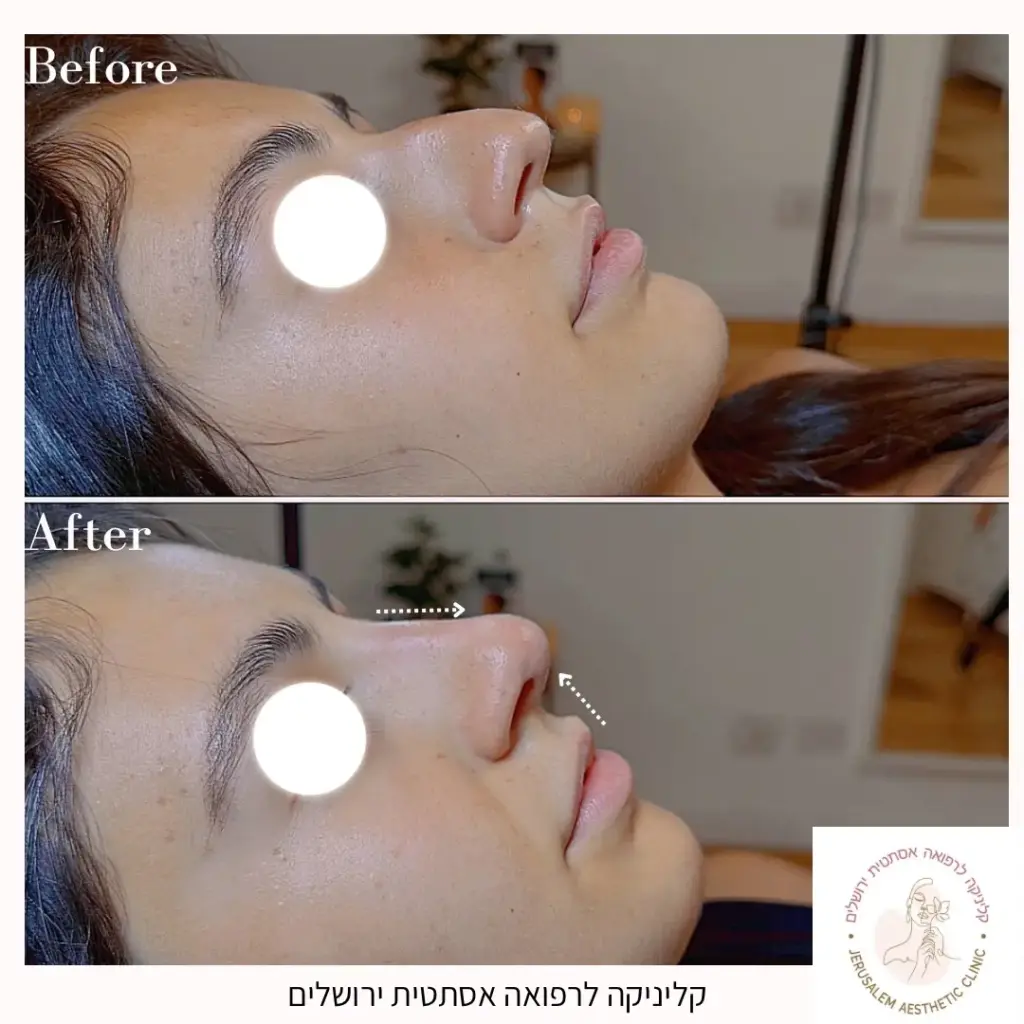 פיסול אף בחומצה האלרונית עם שני שינויים מהותיים