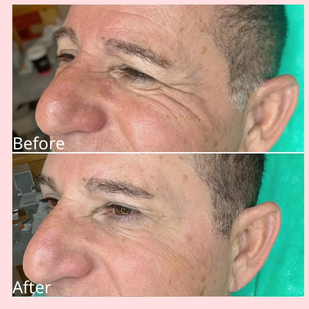 טיפול בצידי עיניים לגבר באמצעות בוטוקס, לפני ואחרי