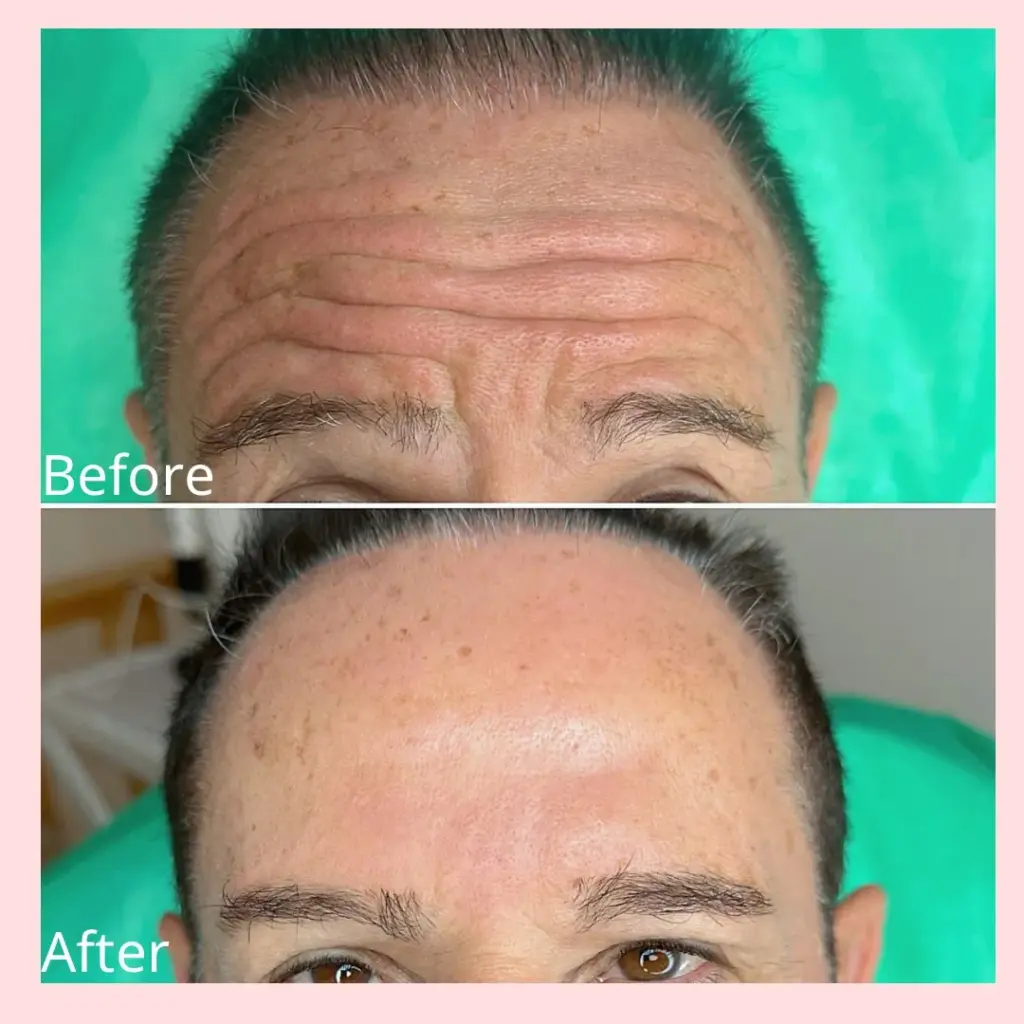 טיפול בוטוקס במצח לגבר - לפני ואחרי
