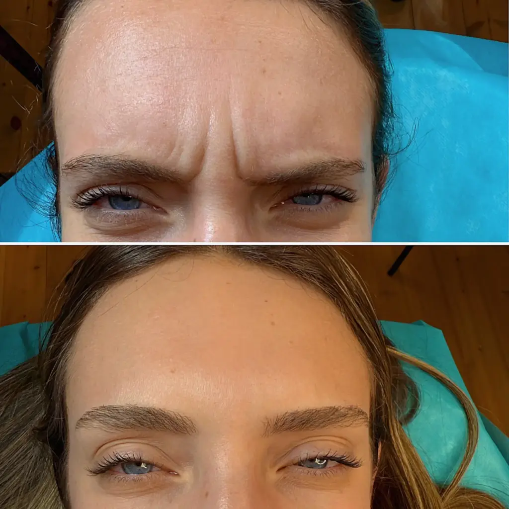 טיפול בוטוקס דיספורט לאישה בשנות ה30 - לפני ואחרי