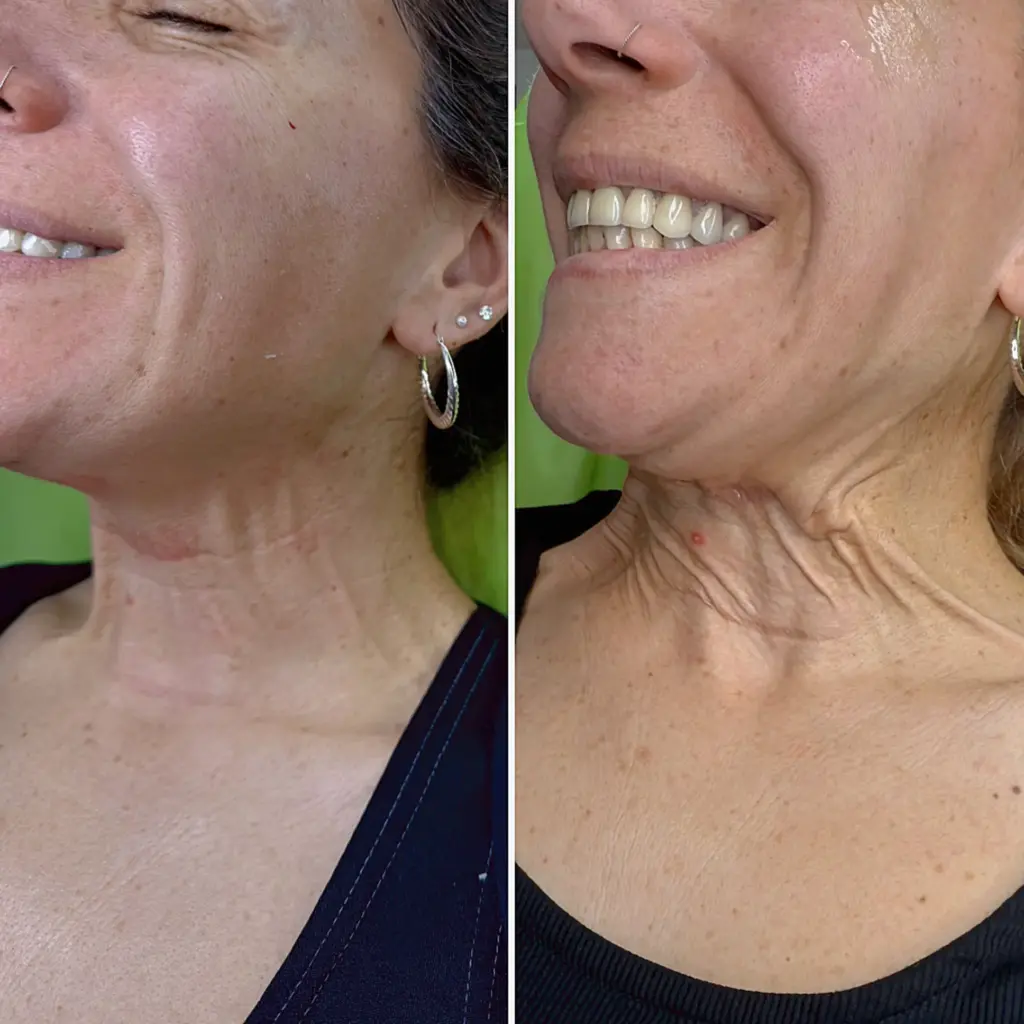 טיפול בפלטיסמה לאישה מבוגרת באמצעות דיספורט בוטוקס