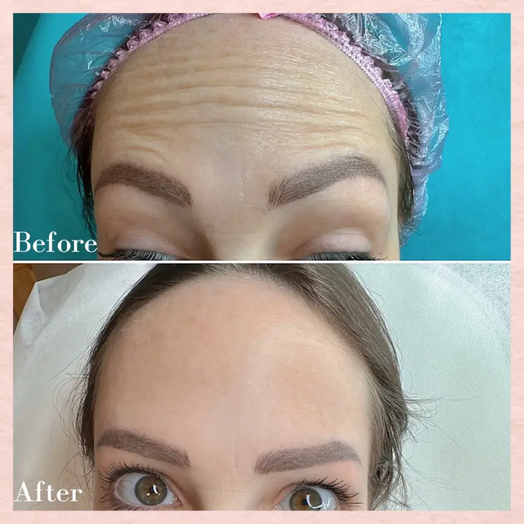 החלקת קמטים במצח לאישה באמצעות טיפול בוטוקס - לפני ואחרי