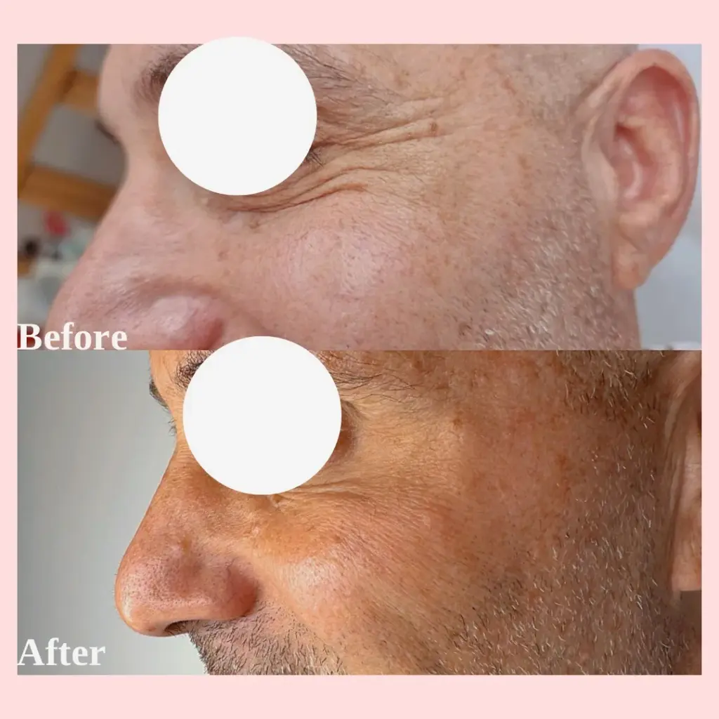 טיפול בצידי עיניים לגבר באמצעות בוטוקס