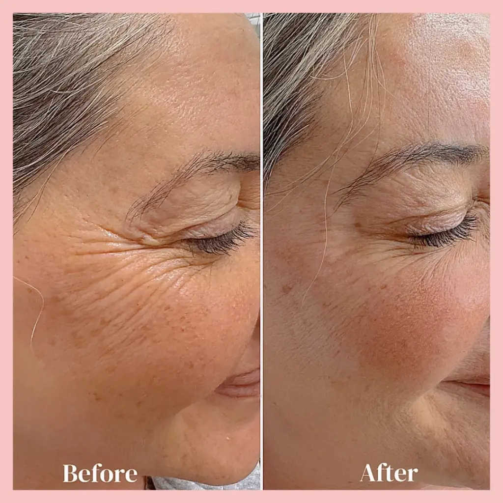 טיפול בצידי הענייים באמצעות דיספורט לאישה