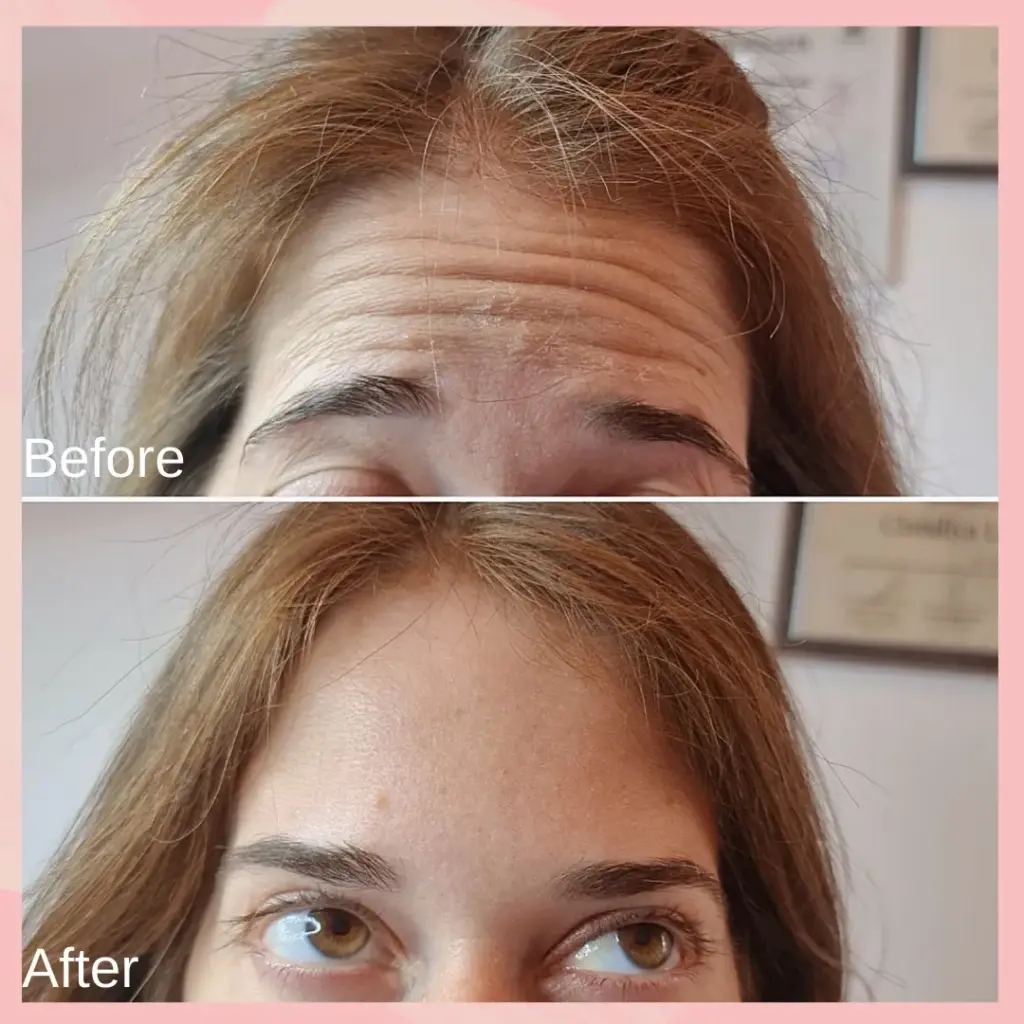 החלקת קמטים במצח לאישה צעירה גינגית באמצעות בוטוקס