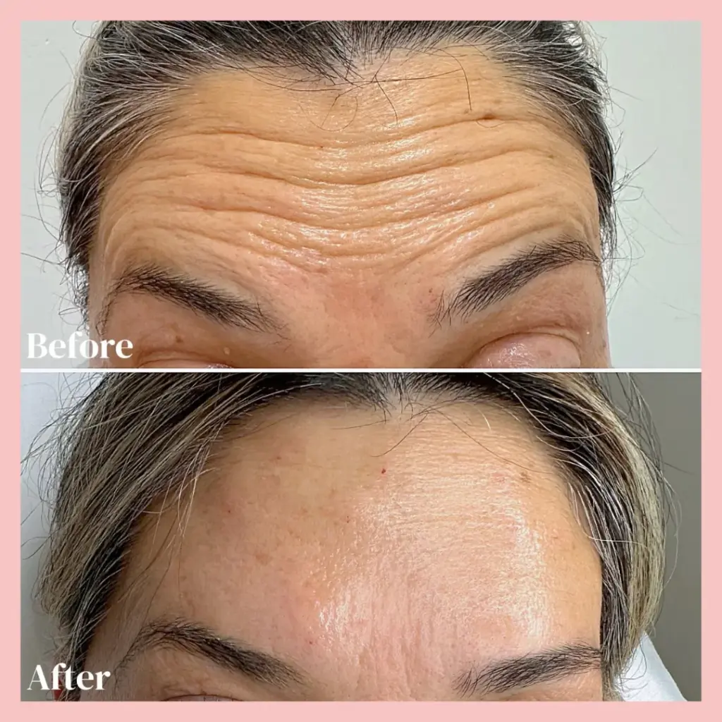 החלקת קמטים לאישה עם דיספורט-בוטוקס