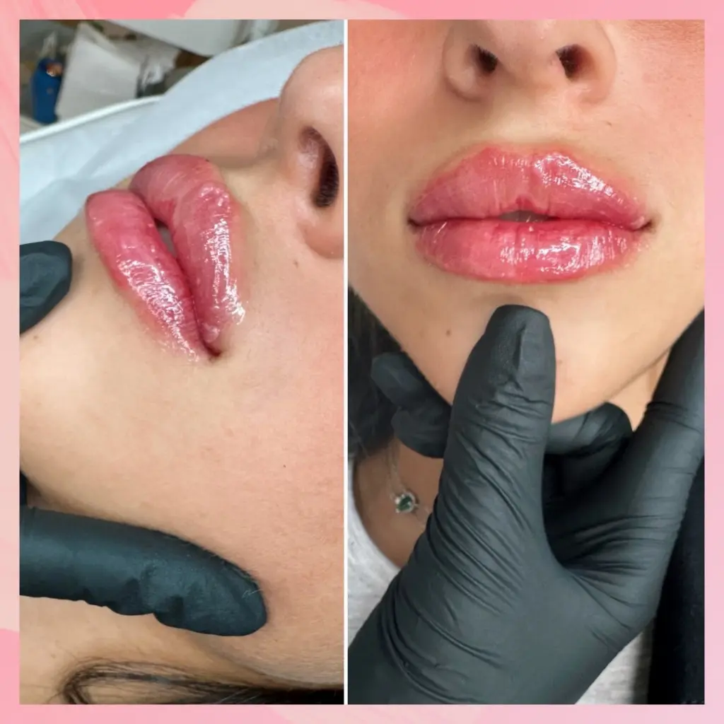 עיבוי שפתיים לבחורה בשנות ה20