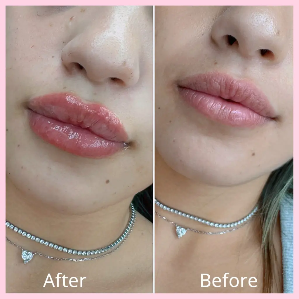 עיצוב, מילוי ועיבוי שפתיים לבחורה צעירה