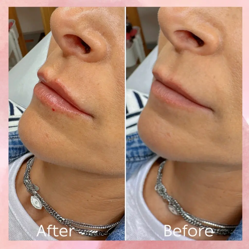 עיצוב ומילוי שפתיים לבחורה בגיל 40