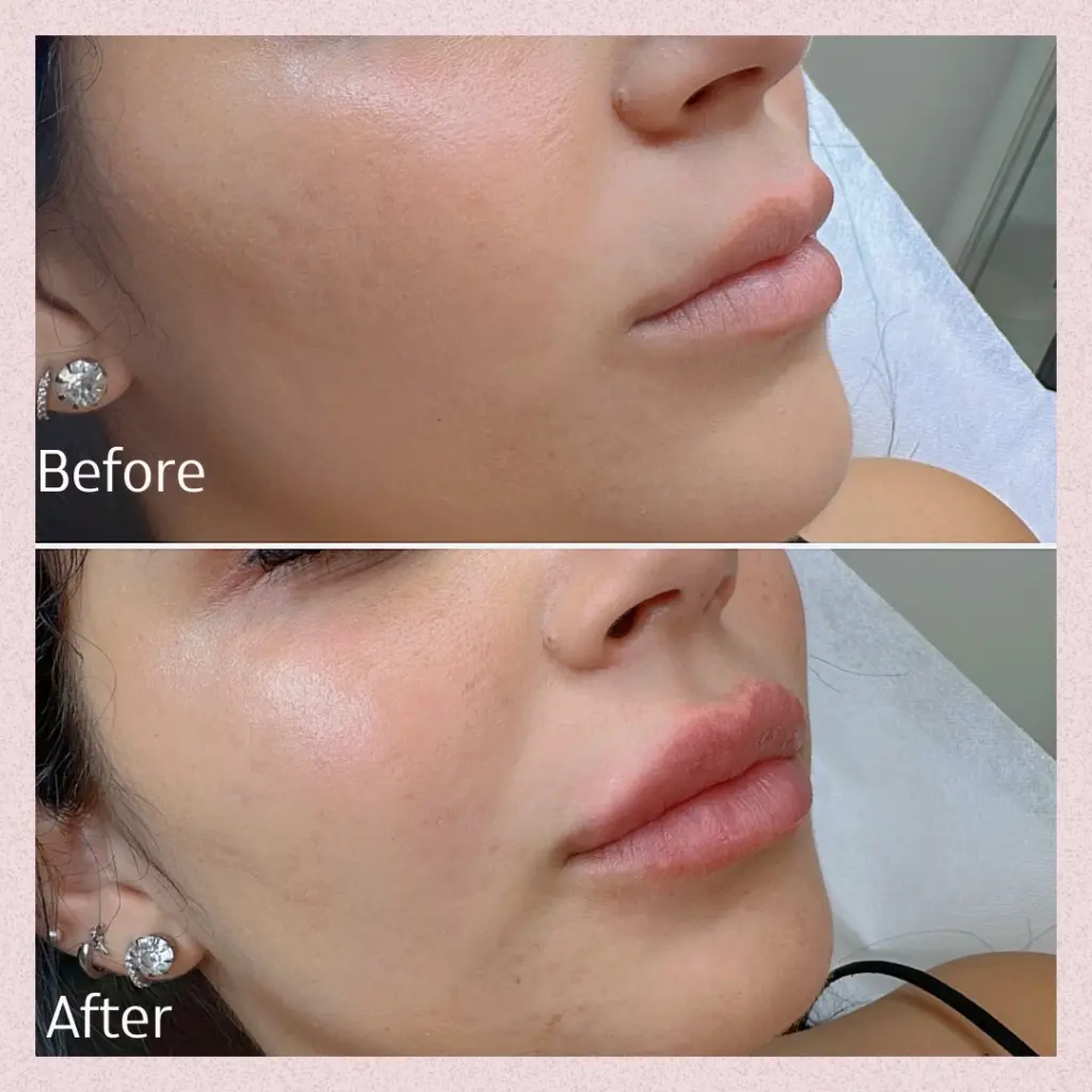 מילוי ועיבוי שפתיים לבחורה צעירה