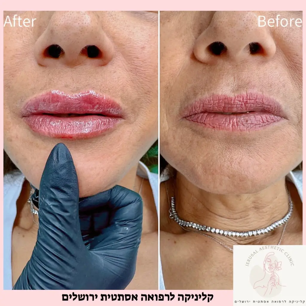 עיבוי שפתיים לבחורה מבוגרת