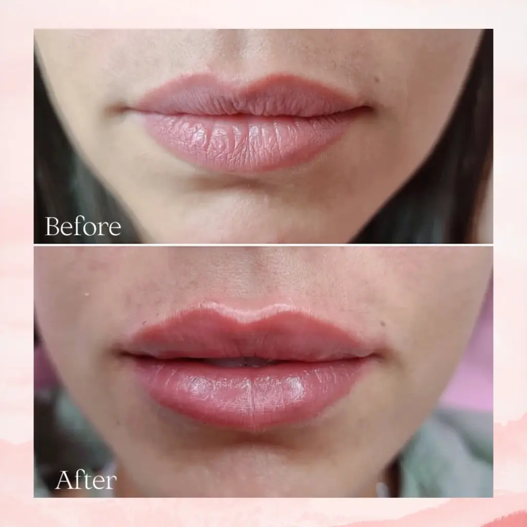 עיצוב שפתיים באמצעות חומצה היאלורונית