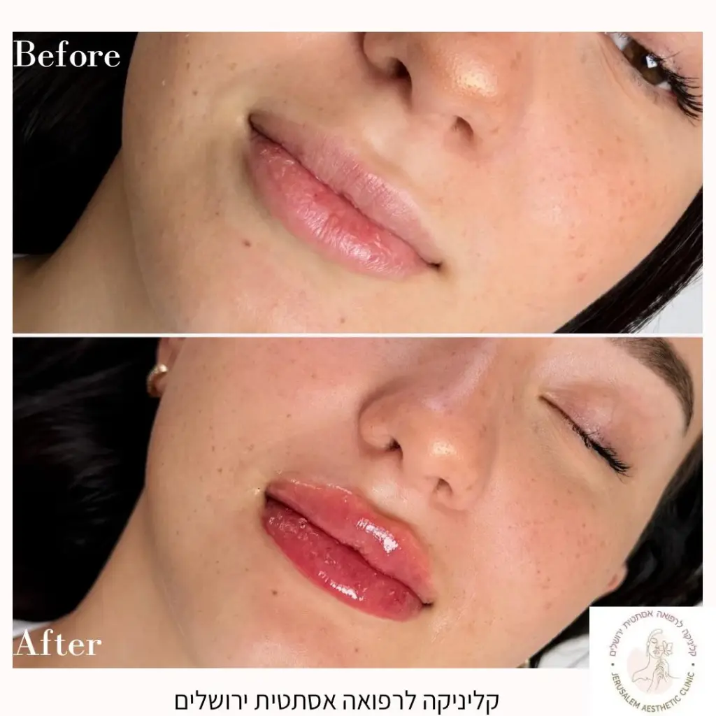 מילוי שפתיים לאישה - מבט קדמי