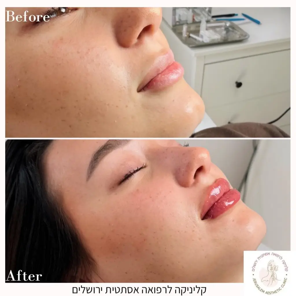 מילוי שפתיים לאישה - מבט מהצד