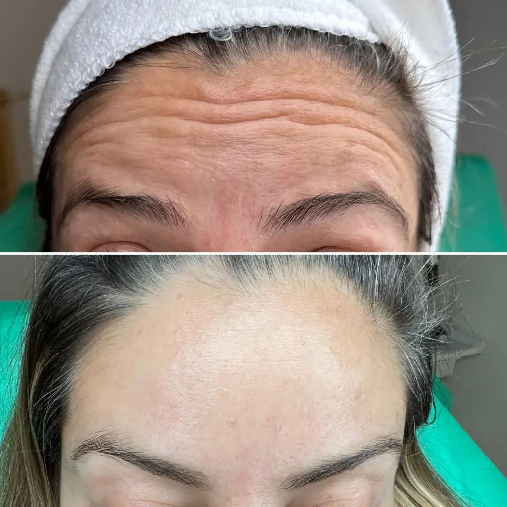 החלקת קמטים לאישה באמצעות בוטוקס-דיספורט במצח