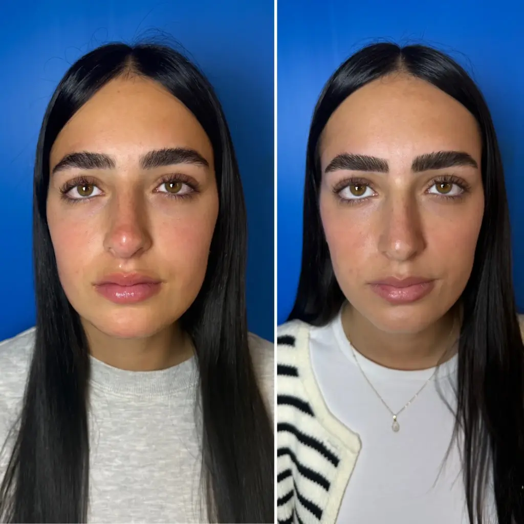 מבט קדמי לפני ואחרי טיפול פיסול אף בחומצה האלרונית שגרם לאף להיות מודגש ומדוייק