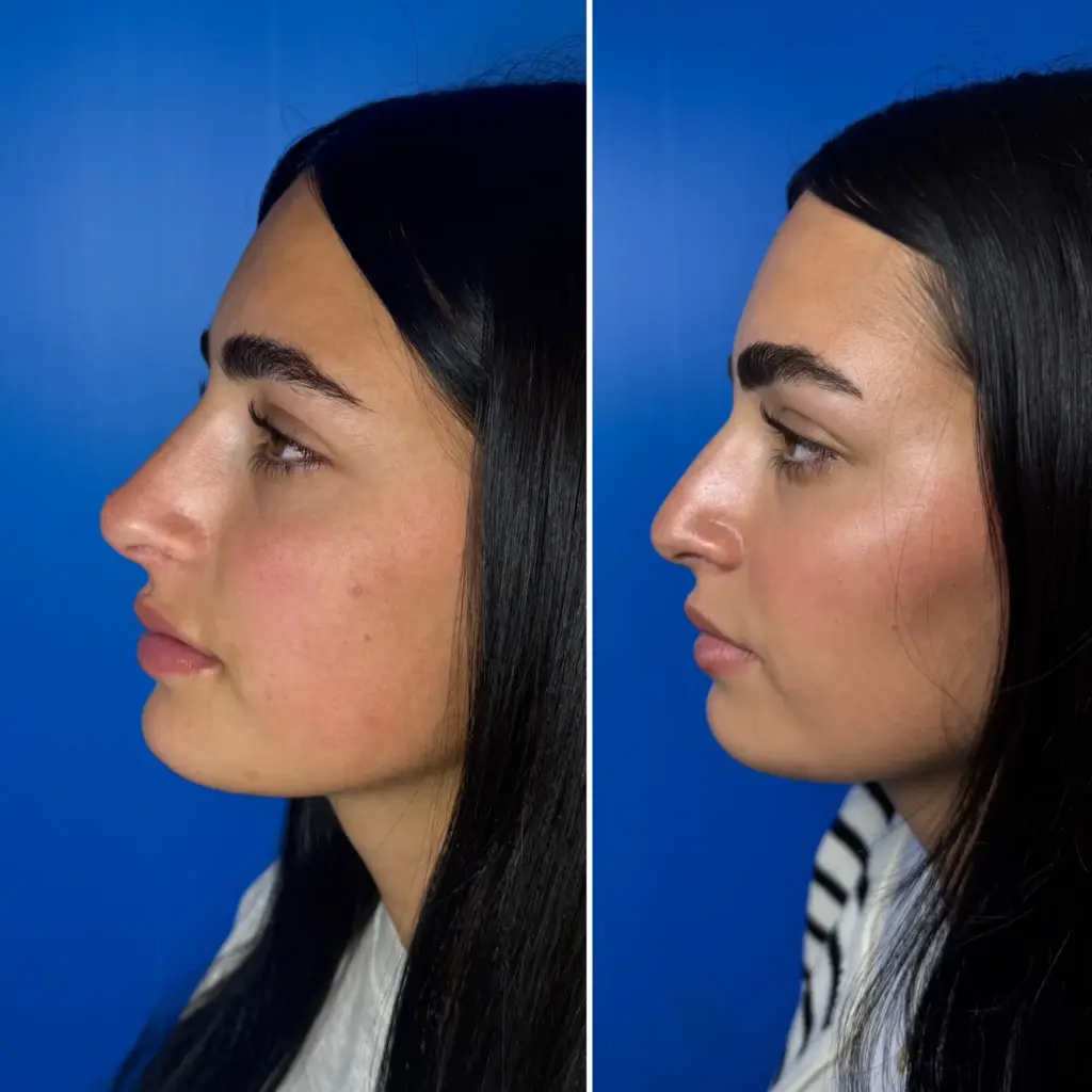 מבט לשמאל לפני ואחרי טיפול פיסול אף בחומצה האלרונית שגרם לאף להיות מודגש ומדוייק