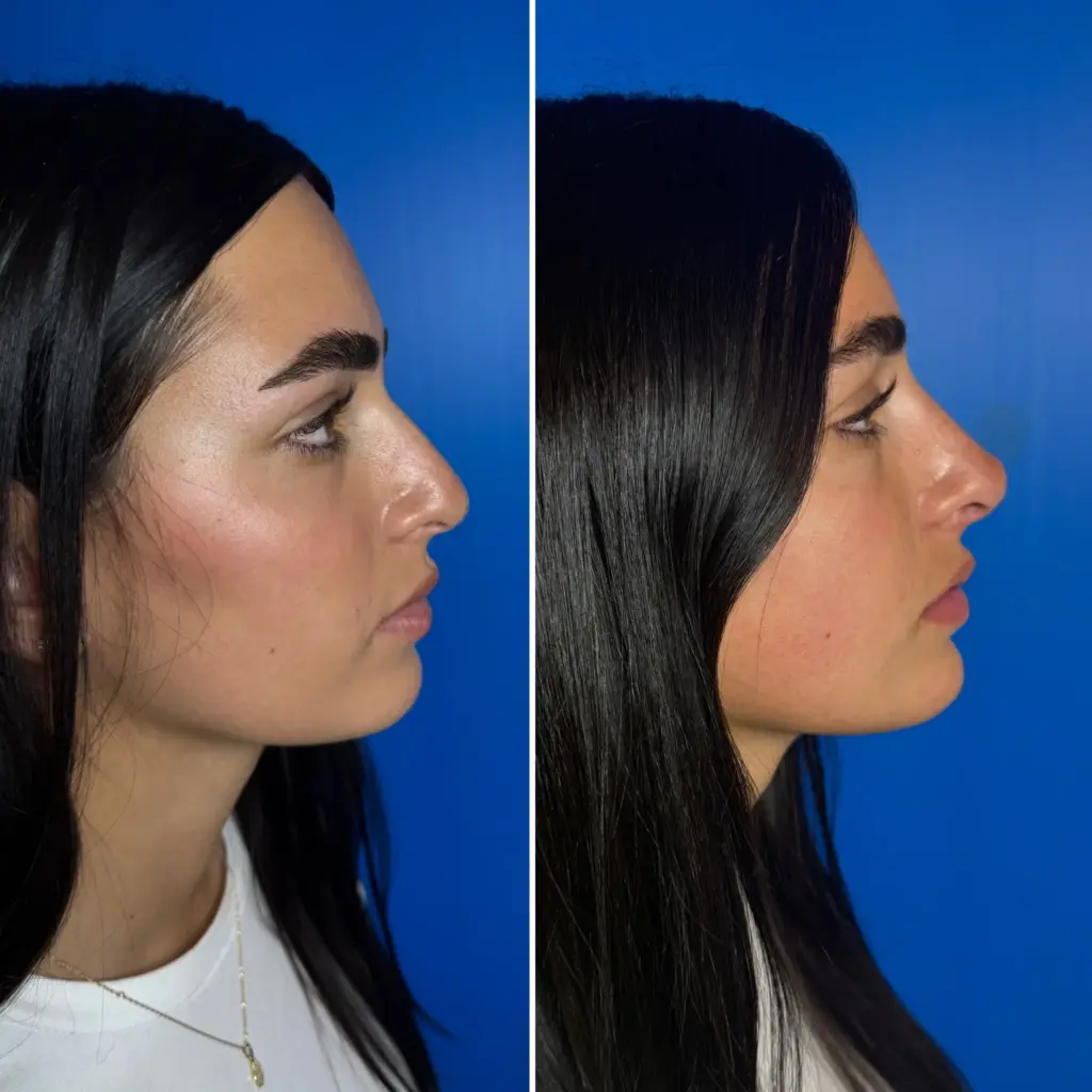 מבט לימין לפני ואחרי טיפול פיסול אף בחומצה האלרונית שגרם לאף להיות מודגש ומדוייק