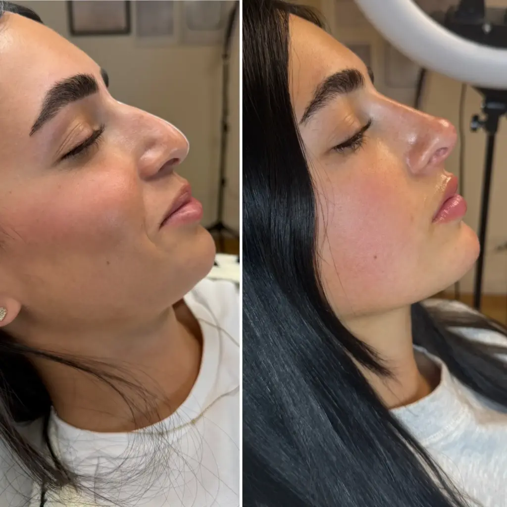 לפני ואחרי פיסול אף לאישה