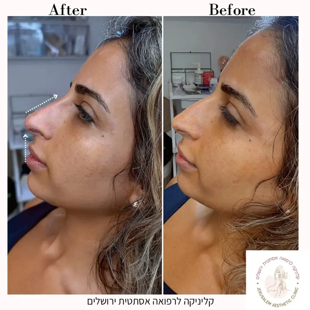 לפני ואחרי פיסול אף לאישה שבו נעשה יישור האף ותיקון הגבנון
