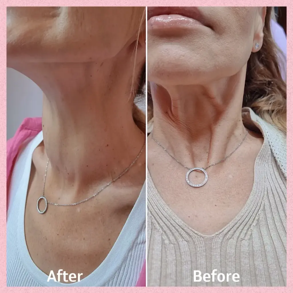 טיפול בפלטיסמה - החלקת קמטים באמצעות דיספורט