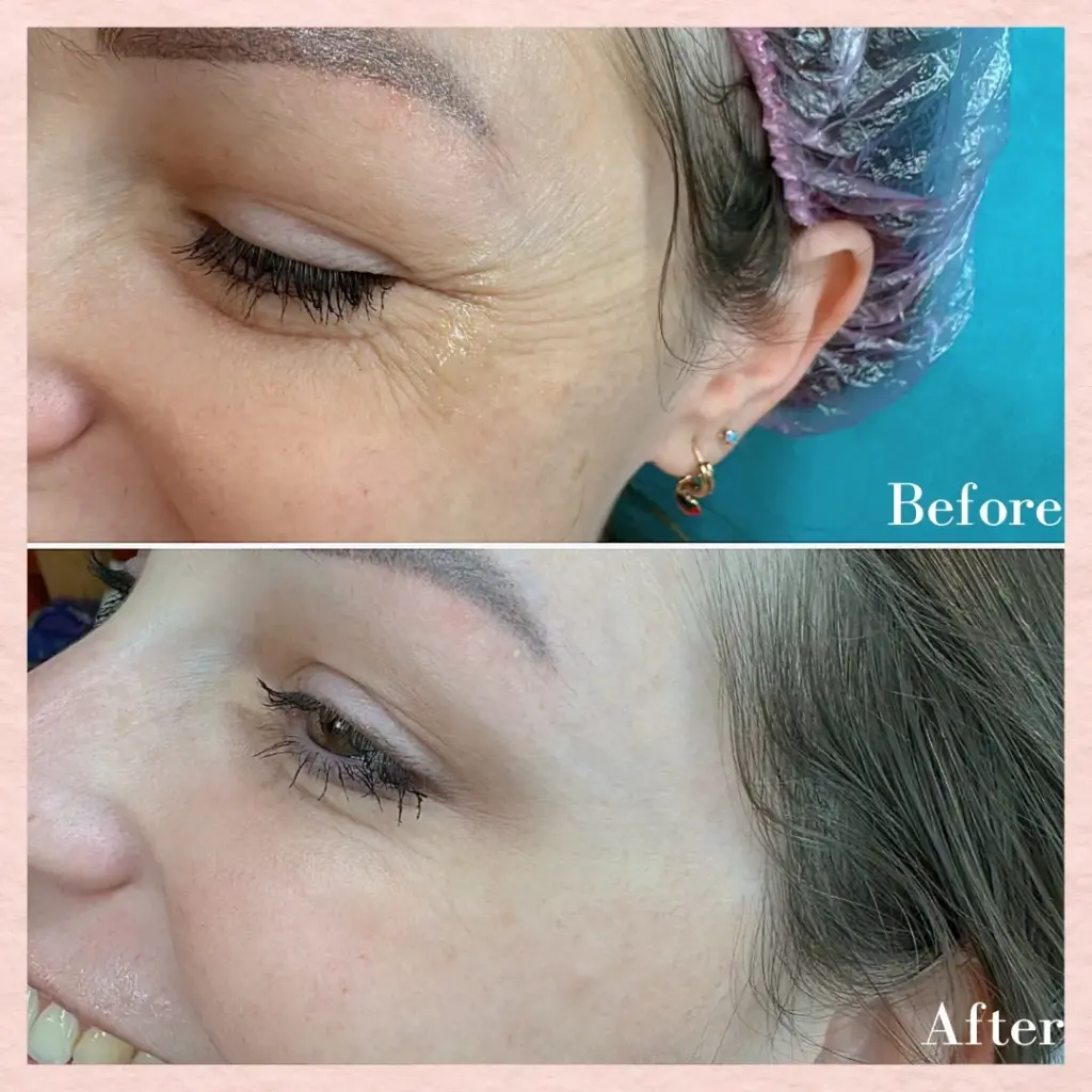 טיפול בצידי עיניים באמצעות דיספורט לאישה - לפני ואחרי