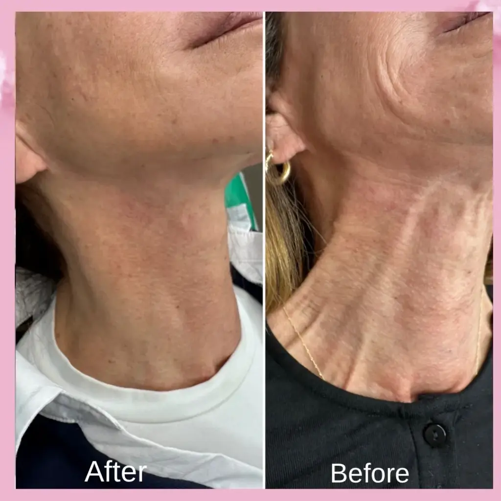 טיפול בפלטיסמה - לפני ואחרי באמצעות בוטוקס-דיספורט