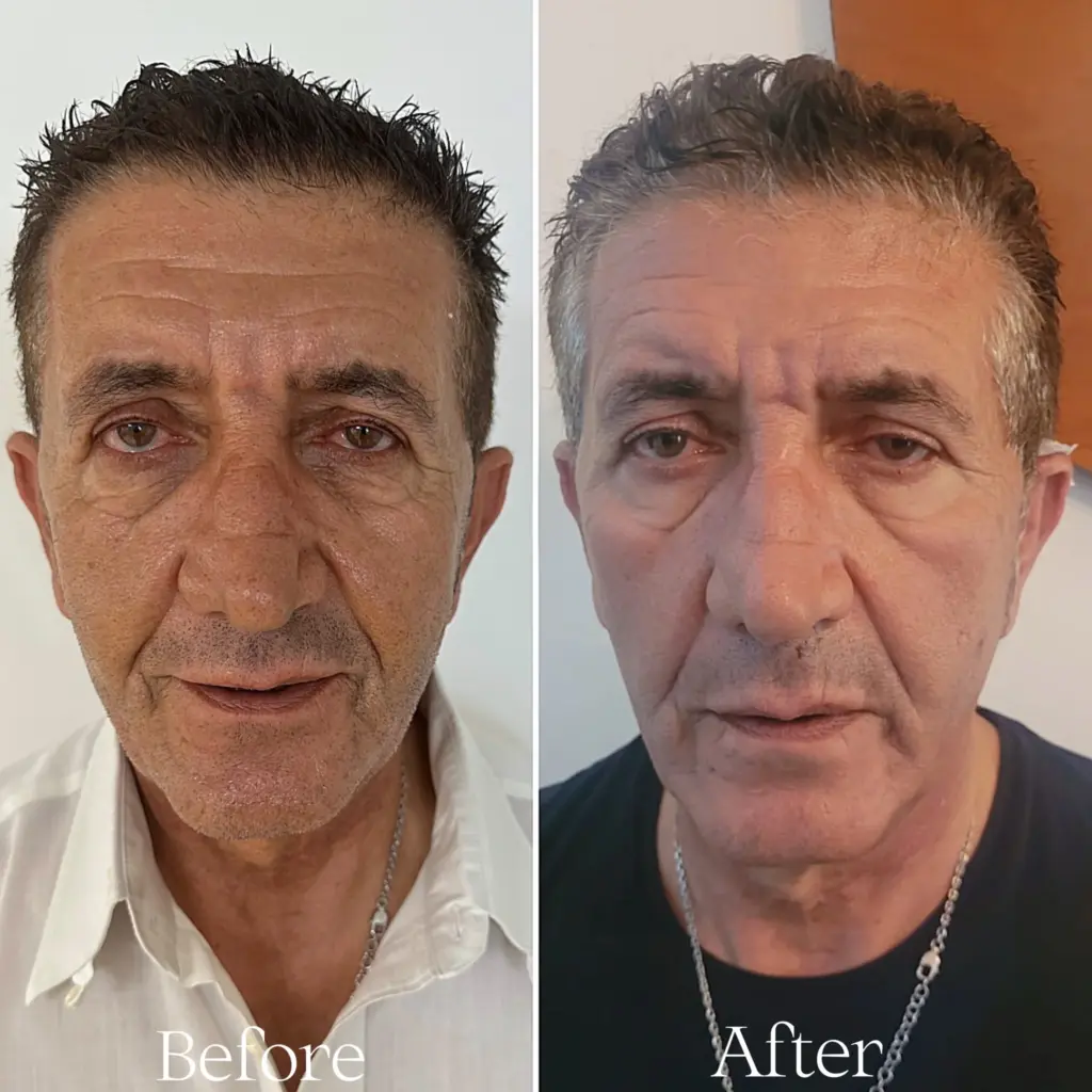 טיפול אסטפיל לגברים עור בוגר