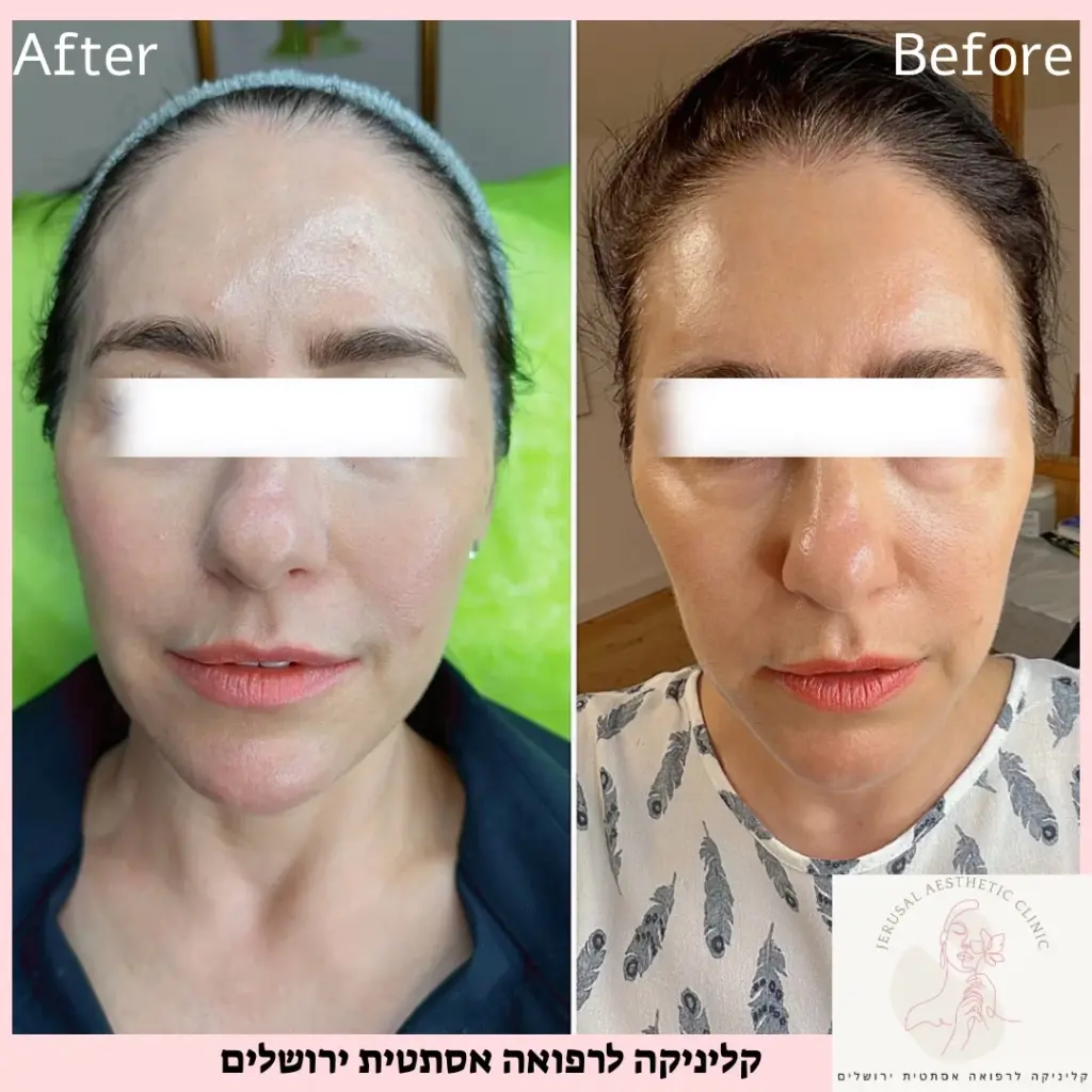 טיפול אסטפיל לנשים מתיחה טבעית
