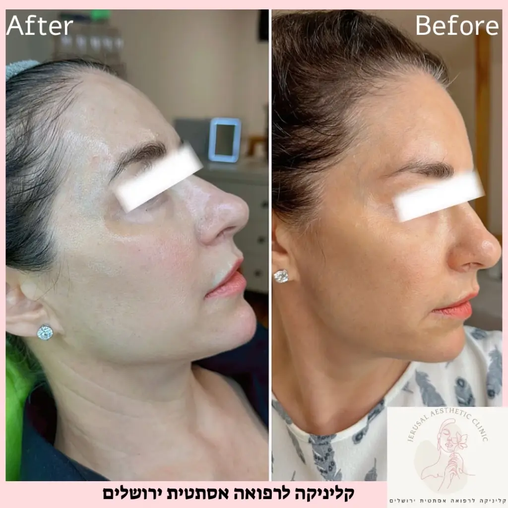 טיפול אסטפיל לנשים מתיחה טבעית עידוד קולגן ואלסטין