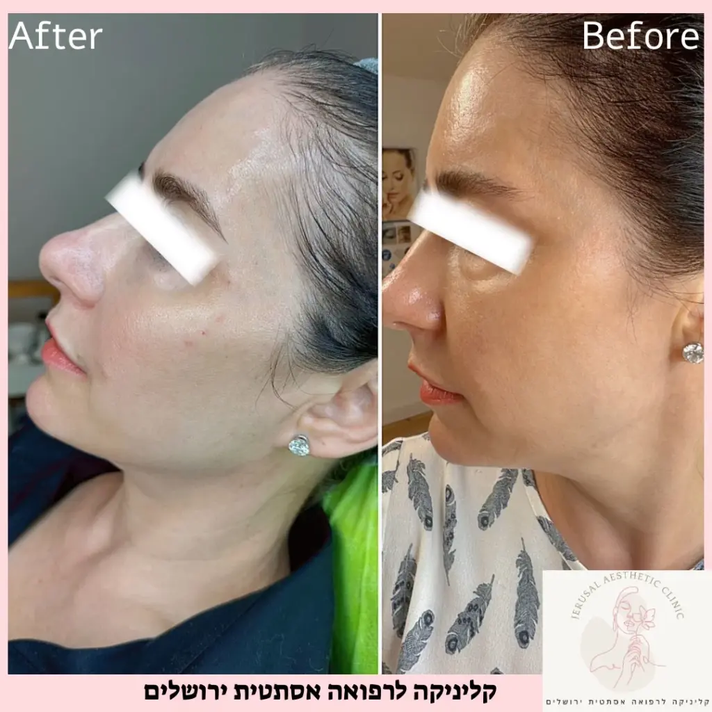טיפול אסטפיל לנשים מתיחה טבעית עידוד קולגן ואלסטין