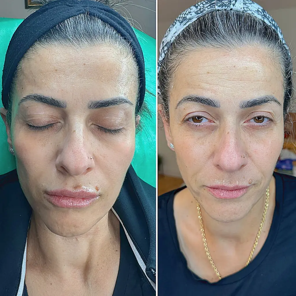 טיפול סידן לפני אחרי