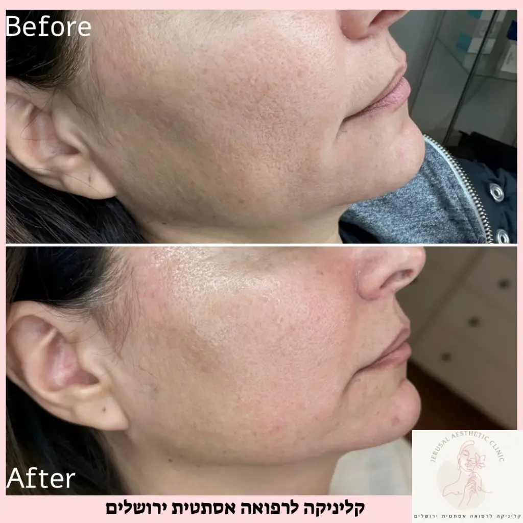 טיפול סידן לפני אחרי