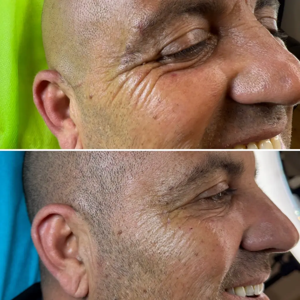 בוטוקס גברים קמטי צידי העיניים
