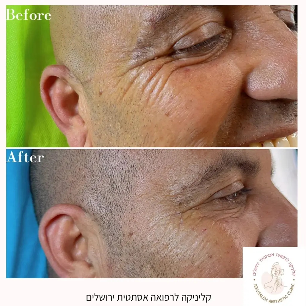 בוטוקס גברים לפני אחרי צידי העיניים