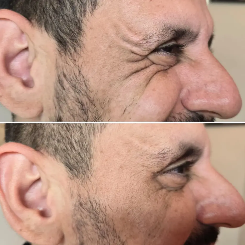 בוטוקס צידי העיניים לגברים