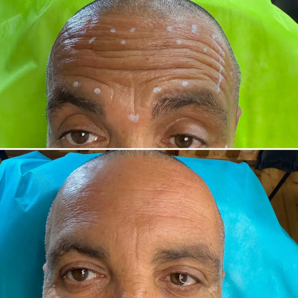 בוטוקס גברים