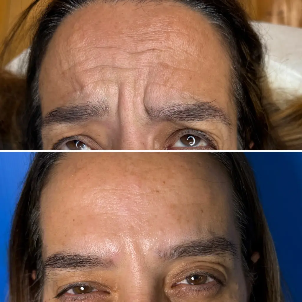 בוטוקס נשים קמט בין הגבות