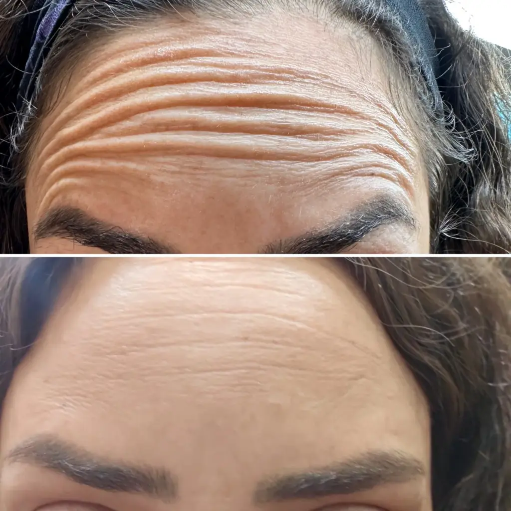 בוטוקס נשים לפני אחרי מצח