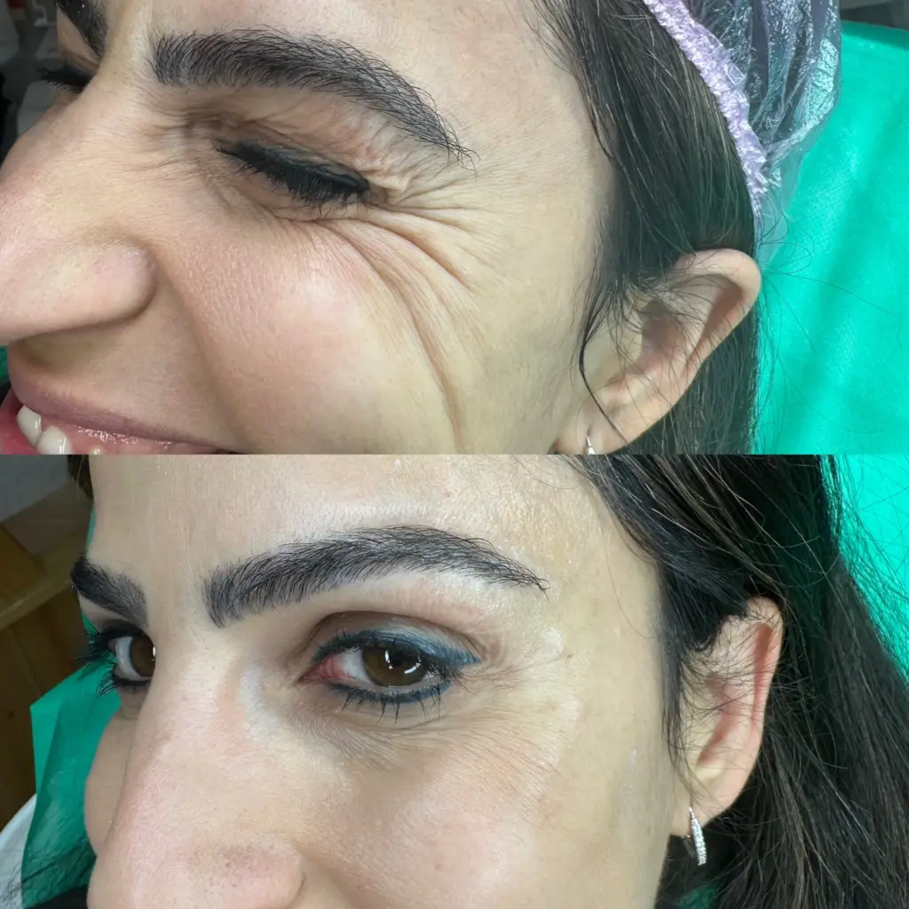 בוטוקס נשים קמטים צידי העיניים