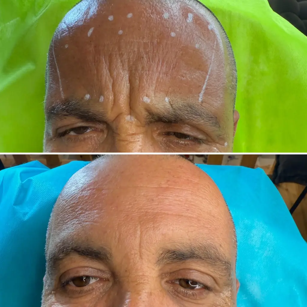 בוטוקס גברים