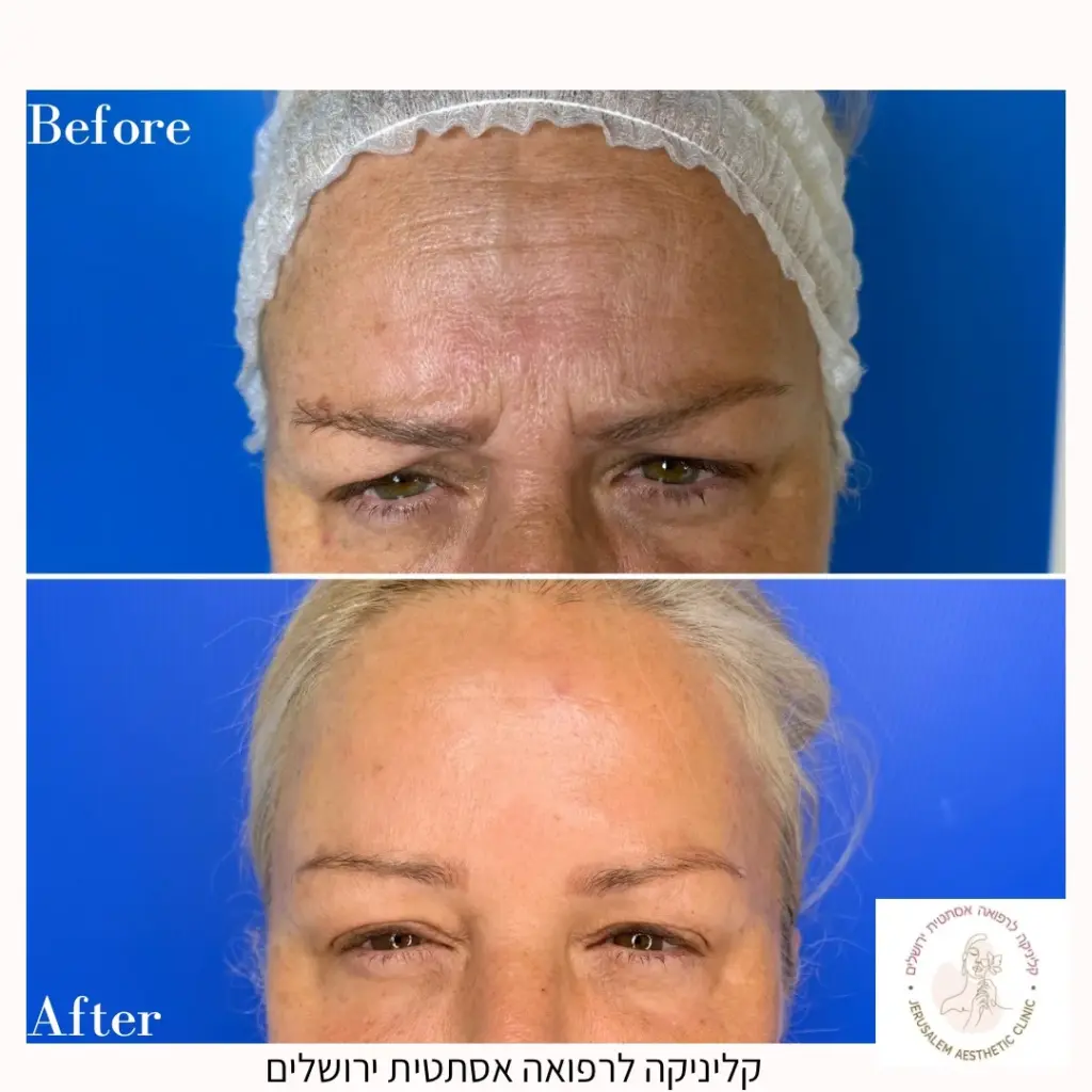 בוטוקס נשים לפני אחרי בין הגבות