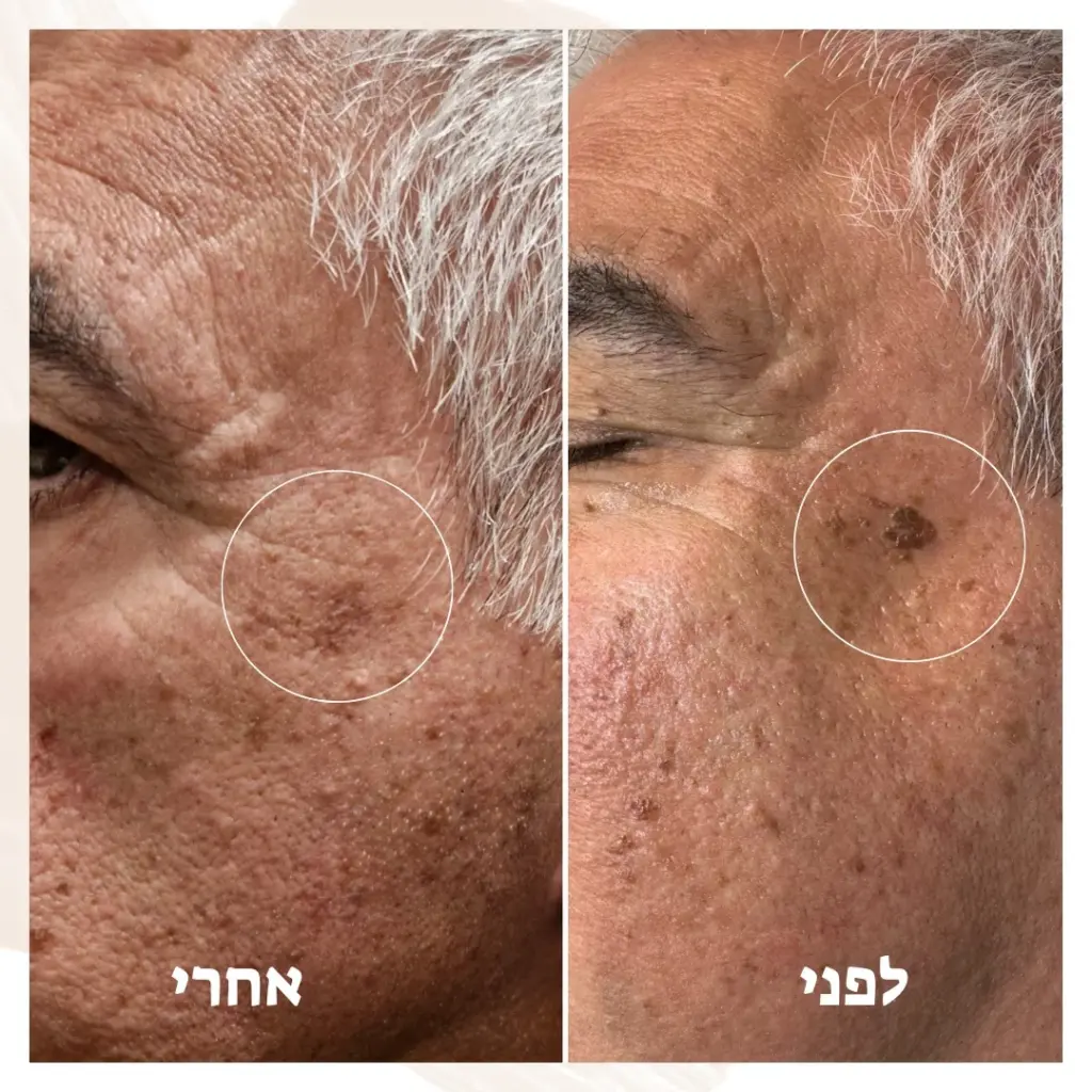 פלזמה רפואית לגברים הסרת כתם מהפנים