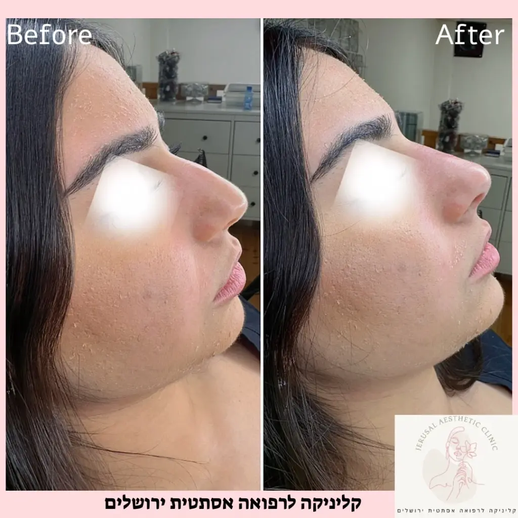 פיסול ועיצוב אף על ידי חומצה היאלרונית