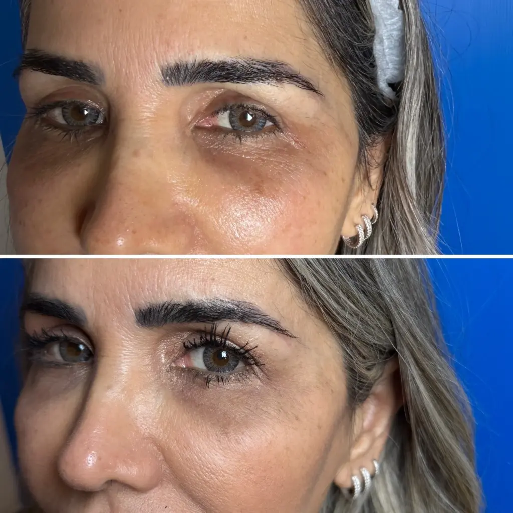 טיפול בזרעי סלומון לכהויות מתחת לעיניים לפני אחרי טיפול 1