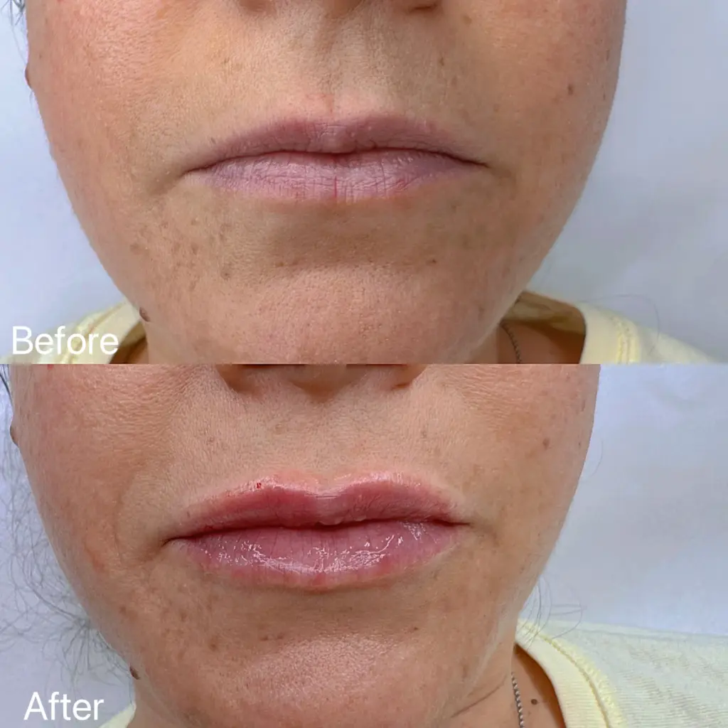 עיבוי ועיצוב שפתיים טבעי -לפני אחרי