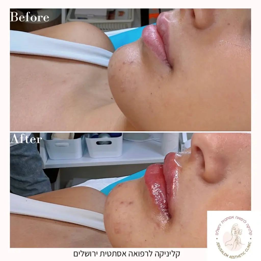 עיבוי ועיצוב שפתיים-לפני אחרי